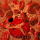 Массовое разрушение этитроцитов крови (гемолиз) приводит к высвобождению большого количества гемоглобина